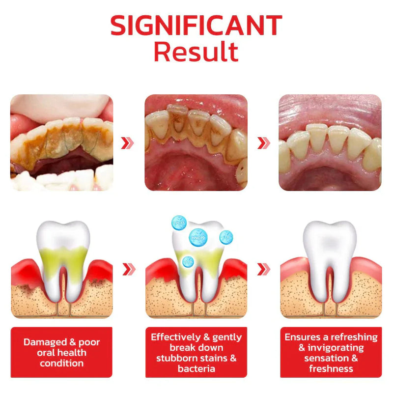 BrightenUp™ - SP-4 Ultra+ Teeth Whitening W Free Mist