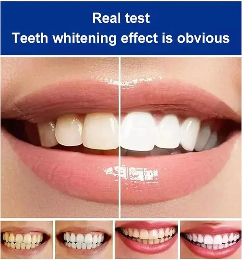 BrightenUp™ - SP-4 Ultra+ Teeth Whitening W Free Mist